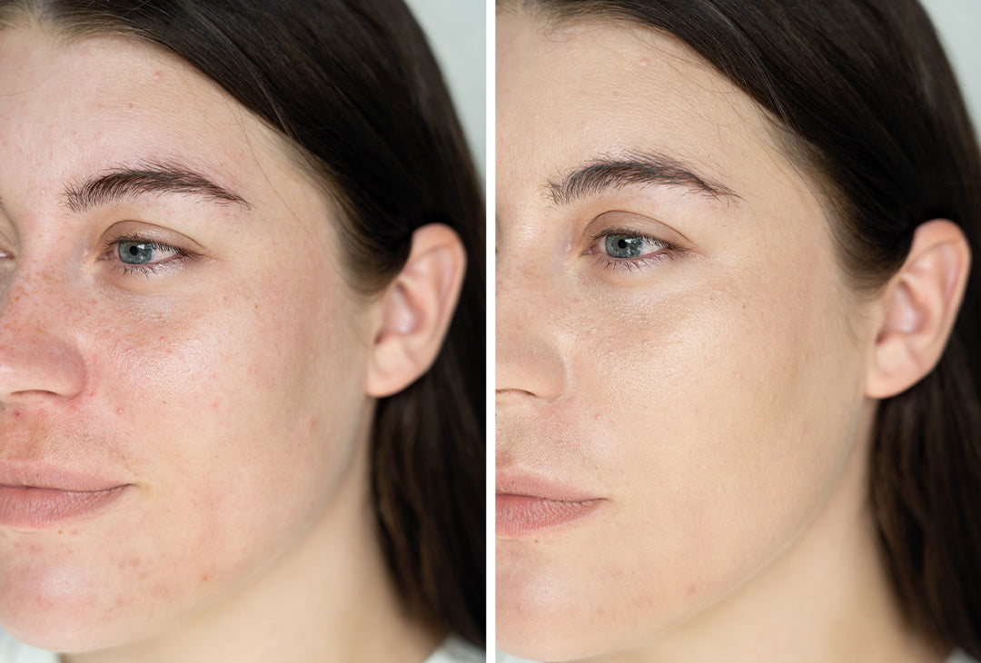 Sådan dækker du rødme effektivt