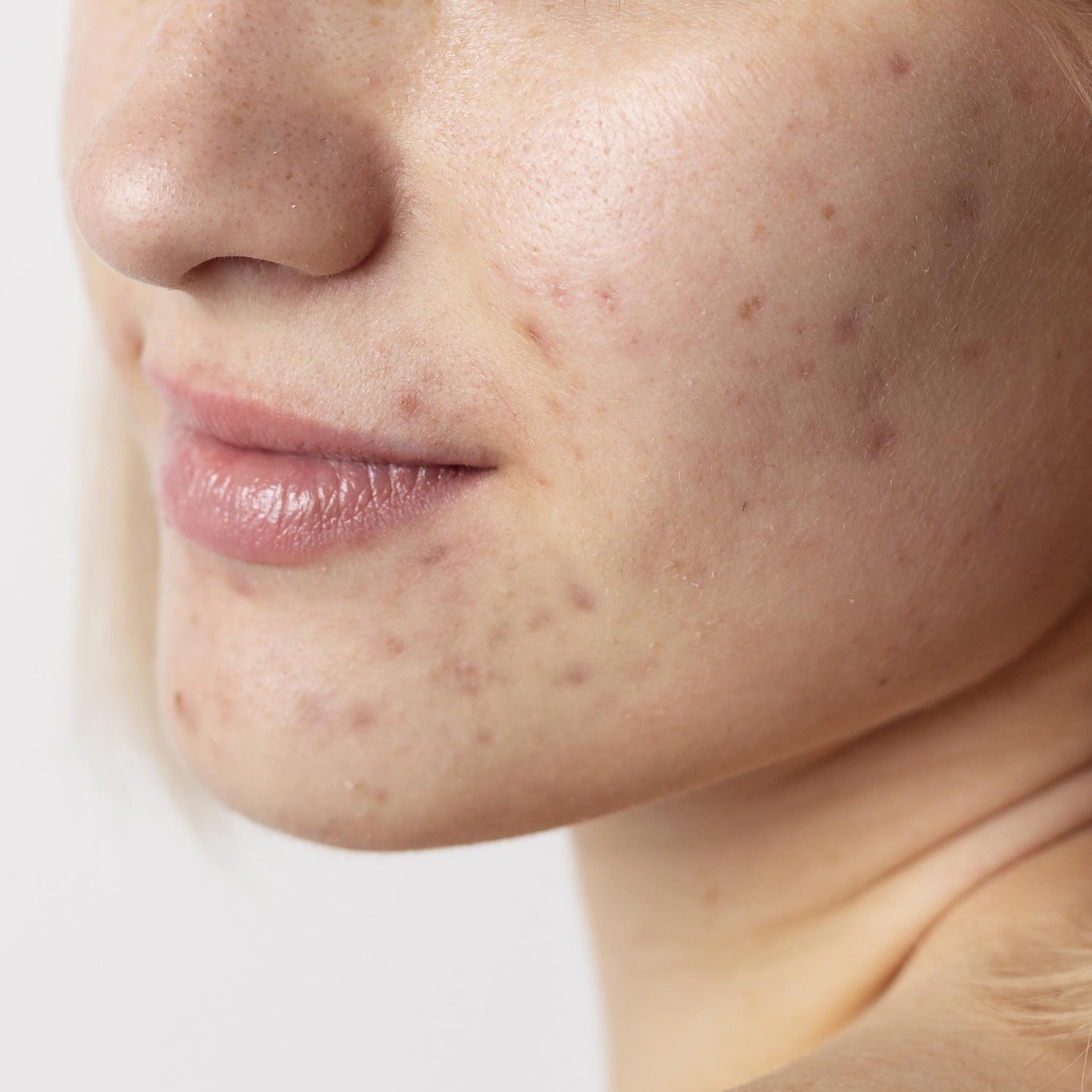 Sådan slipper du af med uren hud og bumser