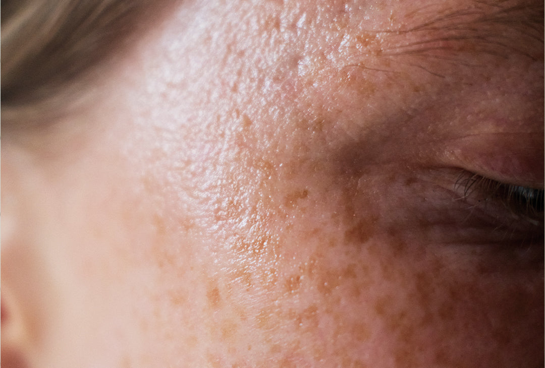 Bliv klogere på pigmentpletter