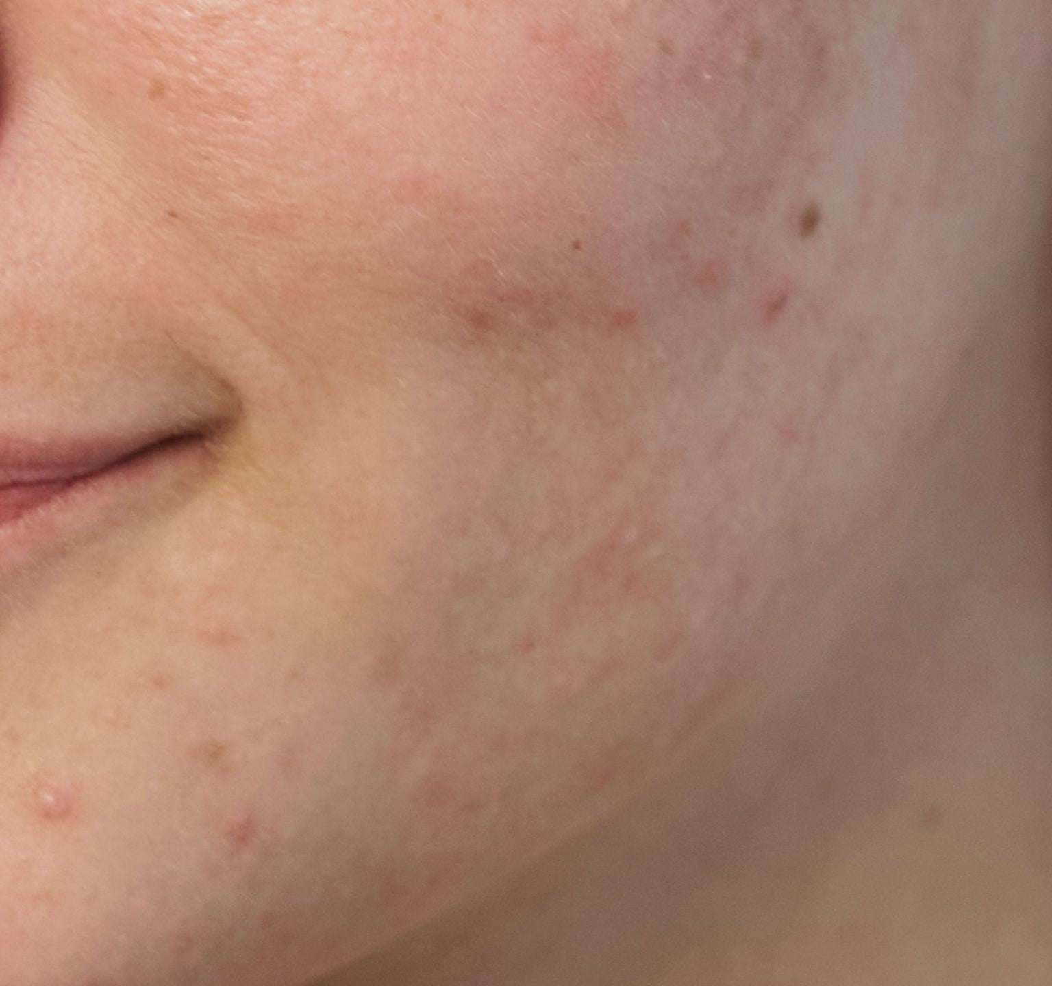 Sådan forebygger og behandler du talgknopper